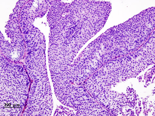 Histopathology of urothelial carcinoma of the urinary bladder. Transurethral biopsy. H&E stain.