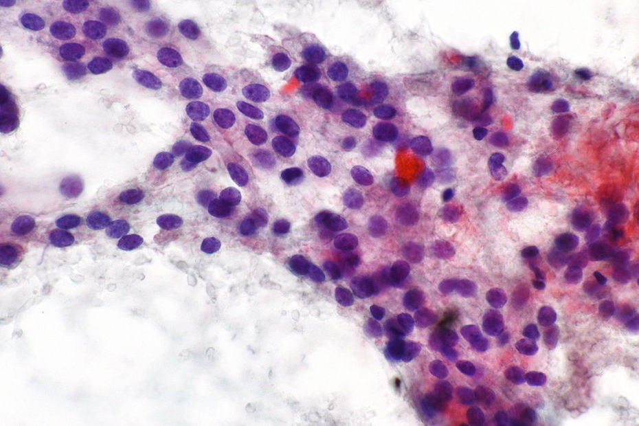 Hürthle cells in a benign thyroid fine needle aspiration (FNA)