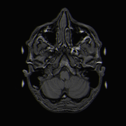 T1-weighted magnetic resonance imaging (MRI) of a normal brain